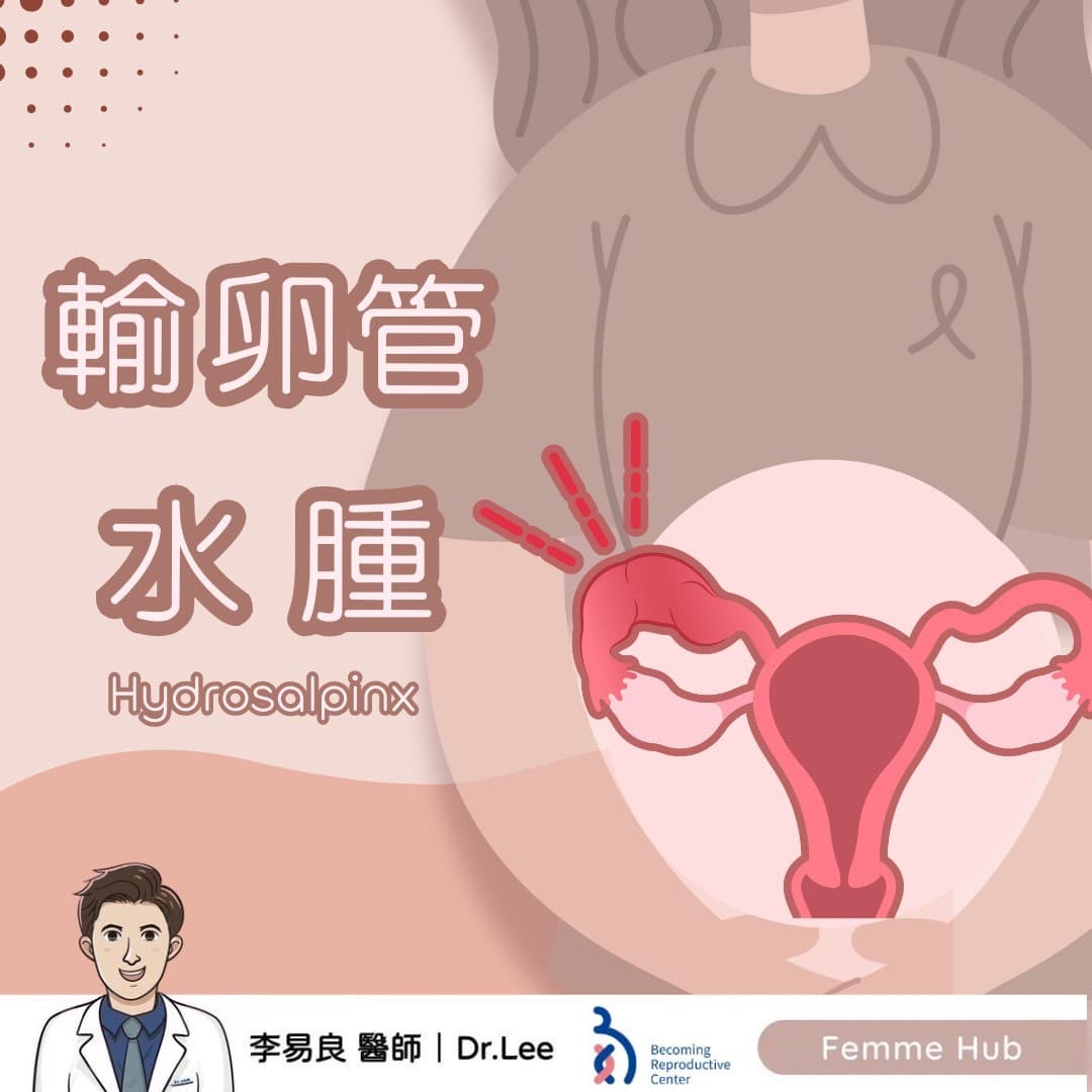👨🏻‍⚕什麼是輸卵管水腫（Hydrosalpinx）？ 『 下篇 』.jpg