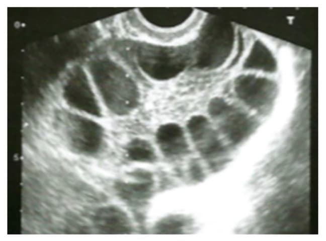 👩‍🏫【淺談多囊性卵巢症候群(PCOS)】1.jpg