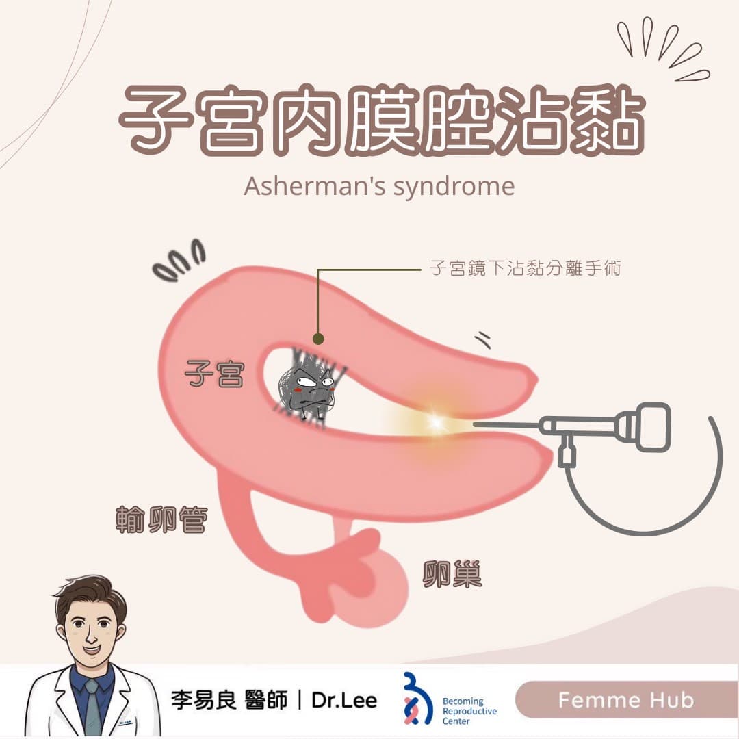 什麼是「子宮內膜腔沾黏」？.jpg