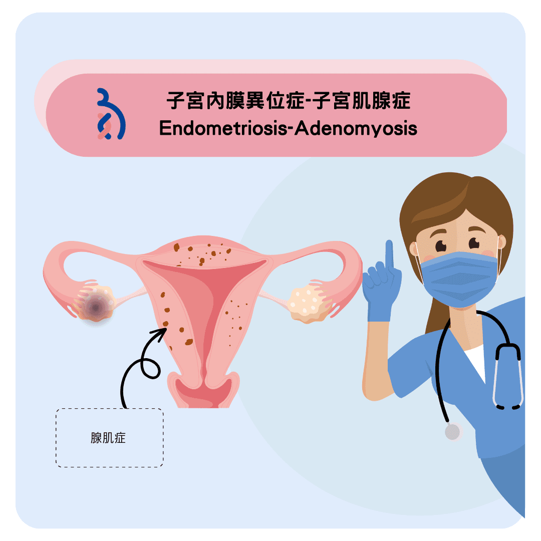認識子宮腺瘤 .png